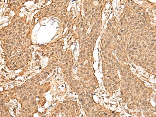 Immunohistochemistry of paraffin-embedded Human esophagus cancer tissue using TIPRL Polyclonal Antibody at dilution of 1:60(×200)