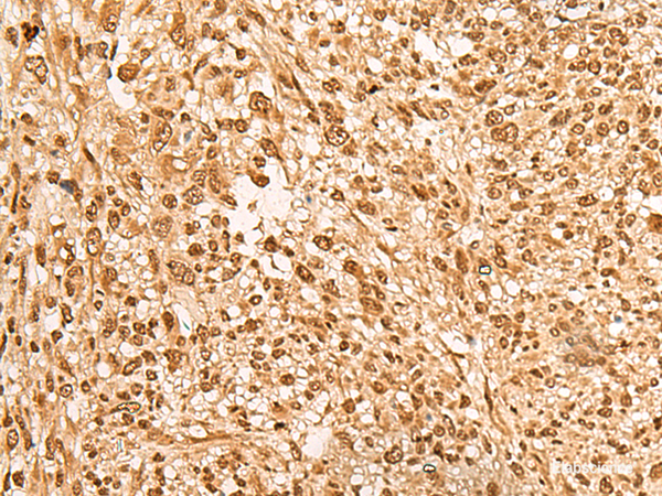 Immunohistochemistry of paraffin-embedded Human liver cancer tissue using JPT2 Polyclonal Antibody at dilution of 1:65(×200)