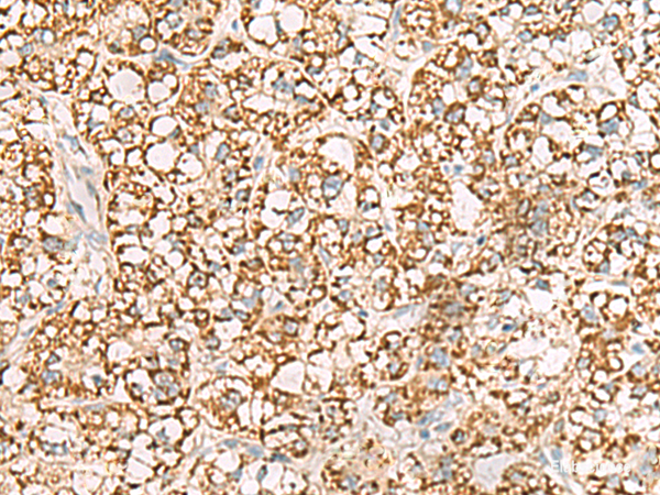 Immunohistochemistry of paraffin-embedded Human liver cancer tissue using ISOC2 Polyclonal Antibody at dilution of 1:95(×200)