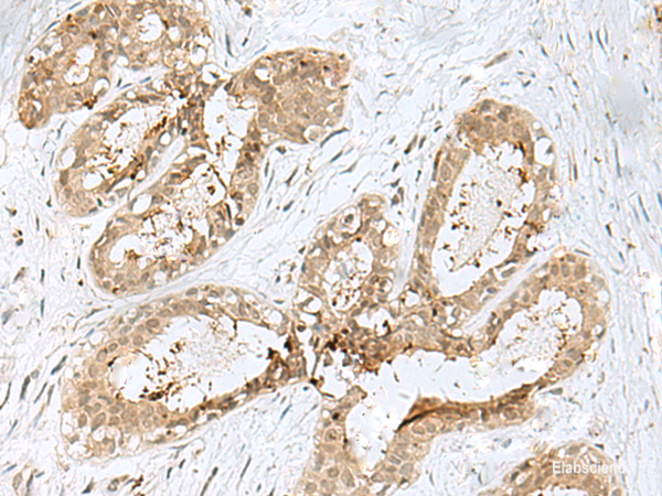 Immunohistochemistry of paraffin-embedded Human breast cancer tissue using PSMA4 Polyclonal Antibody at dilution of 1:45(×200)