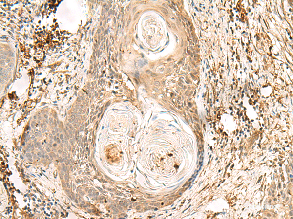 Immunohistochemistry of paraffin-embedded Human esophagus cancer tissue using ZNF397 Polyclonal Antibody at dilution of 1:80(×200)