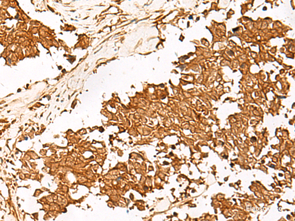 Immunohistochemistry of paraffin-embedded Human lung cancer tissue using HUS1 Polyclonal Antibody at dilution of 1:65(×200)