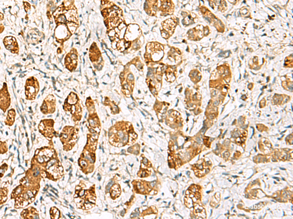 Immunohistochemistry of paraffin-embedded Human liver cancer tissue using RIMS3 Polyclonal Antibody at dilution of 1:60(×200)