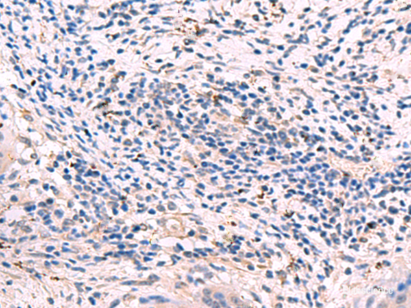 Immunohistochemistry of paraffin-embedded Human cervical cancer tissue using GKAP1 Polyclonal Antibody at dilution of 1:95(×200)