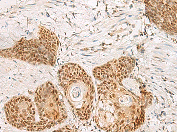 Immunohistochemistry of paraffin-embedded Human esophagus cancer tissue using PSPC1 Polyclonal Antibody at dilution of 1:30(×200)
