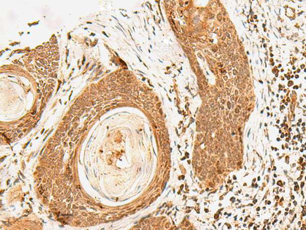 Immunohistochemistry of paraffin-embedded Human esophagus cancer tissue using POLH Polyclonal Antibody at dilution of 1:60(×200)