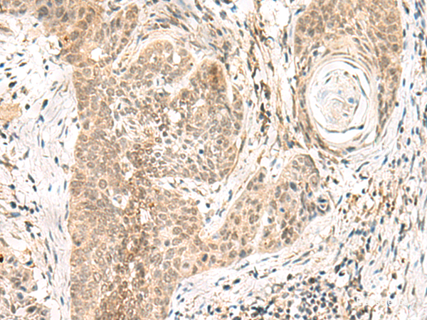 Immunohistochemistry of paraffin-embedded Human esophagus cancer tissue using GPSM1 Polyclonal Antibody at dilution of 1:55(×200)