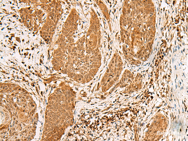Immunohistochemistry of paraffin-embedded Human esophagus cancer tissue using PPOX Polyclonal Antibody at dilution of 1:30(×200)