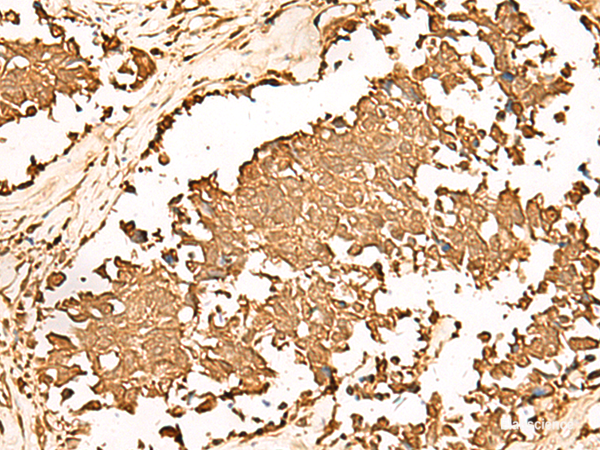 Immunohistochemistry of paraffin-embedded Human lung cancer tissue using PWP1 Polyclonal Antibody at dilution of 1:70(×200)