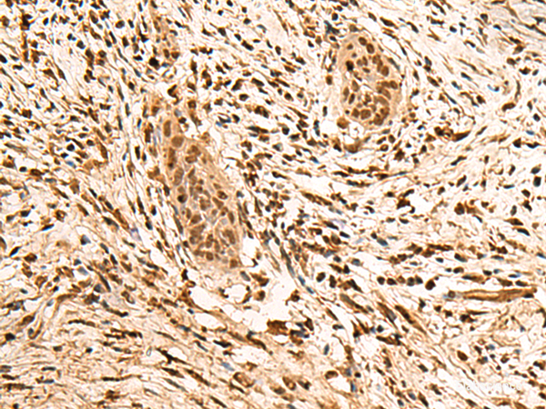 Immunohistochemistry of paraffin-embedded Human esophagus cancer tissue using PPM1G Polyclonal Antibody at dilution of 1:40(×200)