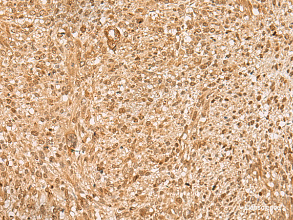 Immunohistochemistry of paraffin-embedded Human liver cancer tissue using HIRIP3 Polyclonal Antibody at dilution of 1:60(×200)