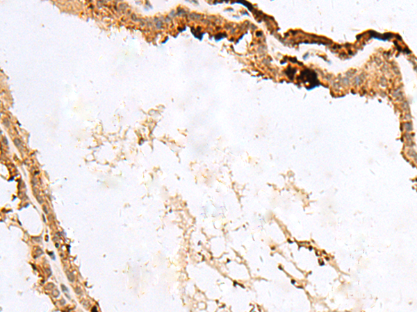 Immunohistochemistry of paraffin-embedded Human thyroid cancer tissue using RABGGTA Polyclonal Antibody at dilution of 1:50(×200)