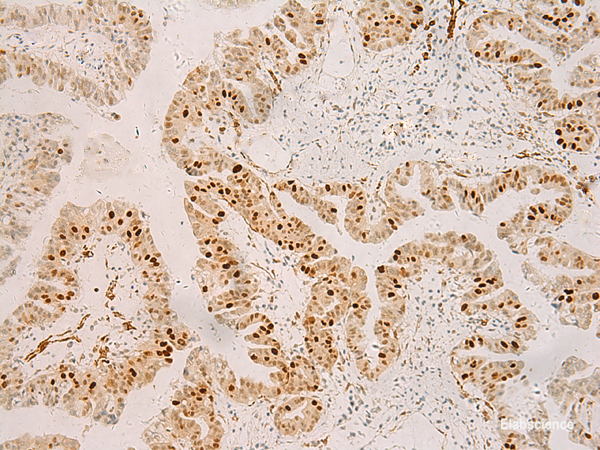 Immunohistochemistry of paraffin-embedded Human liver cancer tissue using RFX6 Polyclonal Antibody at dilution of 1:50(×200)