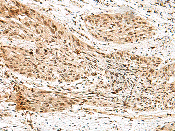 Immunohistochemistry of paraffin-embedded Human esophagus cancer tissue using RBM15 Polyclonal Antibody at dilution of 1:70(×200)