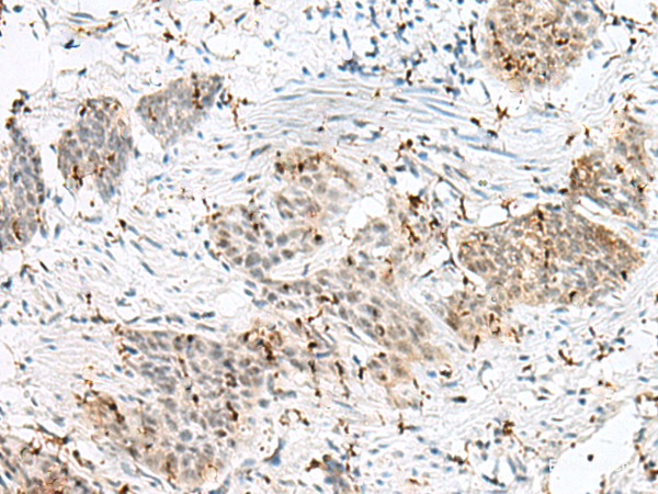 Immunohistochemistry of paraffin-embedded Human esophagus cancer tissue using PLCL2 Polyclonal Antibody at dilution of 1:50(×200)