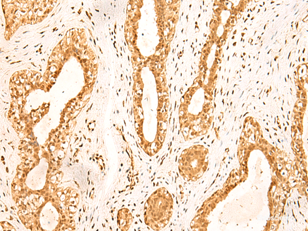 Immunohistochemistry of paraffin-embedded Human breast cancer tissue using ZNF471 Polyclonal Antibody at dilution of 1:50(×200)