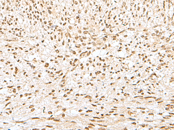 Immunohistochemistry of paraffin-embedded Human liver cancer tissue using GTF2A2 Polyclonal Antibody at dilution of 1:30(×200)