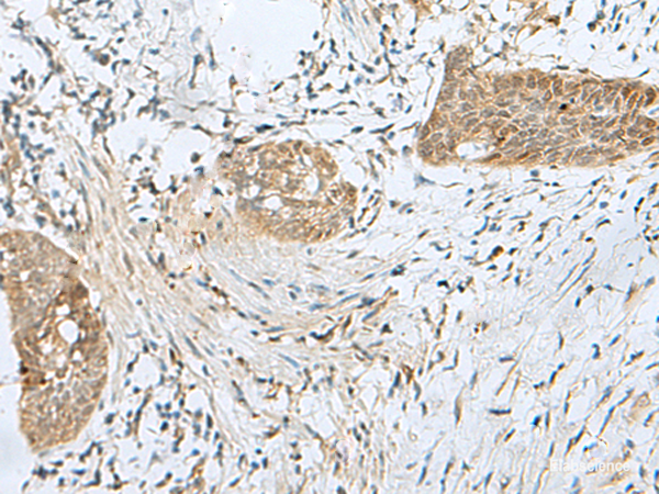 Immunohistochemistry of paraffin-embedded Human esophagus cancer tissue using SNRPD1 Polyclonal Antibody at dilution of 1:70(×200)
