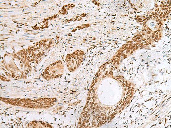 Immunohistochemistry of paraffin-embedded Human esophagus cancer tissue using PNRC2 Polyclonal Antibody at dilution of 1:30(×200)