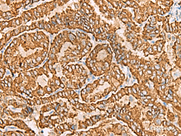 Immunohistochemistry of paraffin-embedded Human thyroid cancer tissue using NPC2 Polyclonal Antibody at dilution of 1:80(×200)