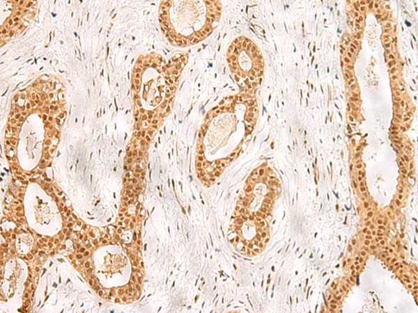 Immunohistochemistry of paraffin-embedded Human breast cancer tissue using RPS27A Polyclonal Antibody at dilution of 1:40(×200)