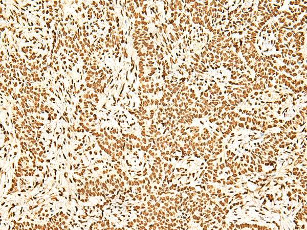 Immunohistochemistry of paraffin-embedded Human ovarian cancer tissue using ILF3 Polyclonal Antibody at dilution of 1:60(×200)