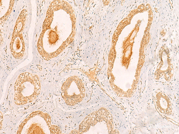 Immunohistochemistry of paraffin-embedded Human breast cancer tissue using ZNF580 Polyclonal Antibody at dilution of 1:40(×200)
