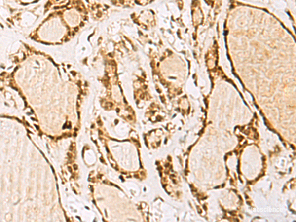 Immunohistochemistry of paraffin-embedded Human thyroid cancer tissue using NIPBL Polyclonal Antibody at dilution of 1:55(×200)