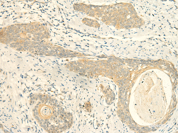Immunohistochemistry of paraffin-embedded Human esophagus cancer tissue using MPV17 Polyclonal Antibody at dilution of 1:50(×200)