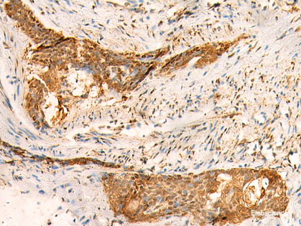 Immunohistochemistry of paraffin-embedded Human esophagus cancer tissue using SMUG1 Polyclonal Antibody at dilution of 1:50(×200)