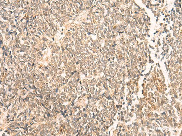 Immunohistochemistry of paraffin-embedded Human lung cancer tissue using NIP7 Polyclonal Antibody at dilution of 1:50(×200)