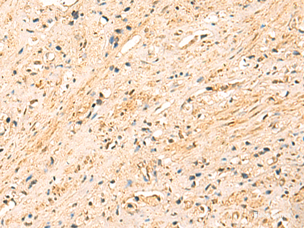 Immunohistochemistry of paraffin-embedded Human prost at e cancer tissue using EEF1AKMT2 Polyclonal Antibody at dilution of 1:50(×200)