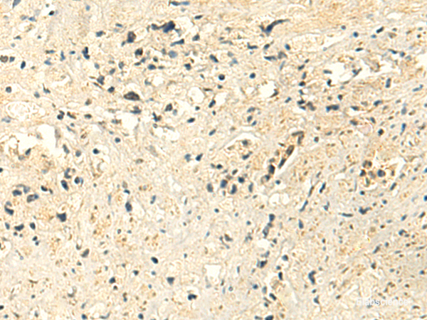 Immunohistochemistry of paraffin-embedded Human prost at e cancer tissue using MTHFS Polyclonal Antibody at dilution of 1:50(×200)