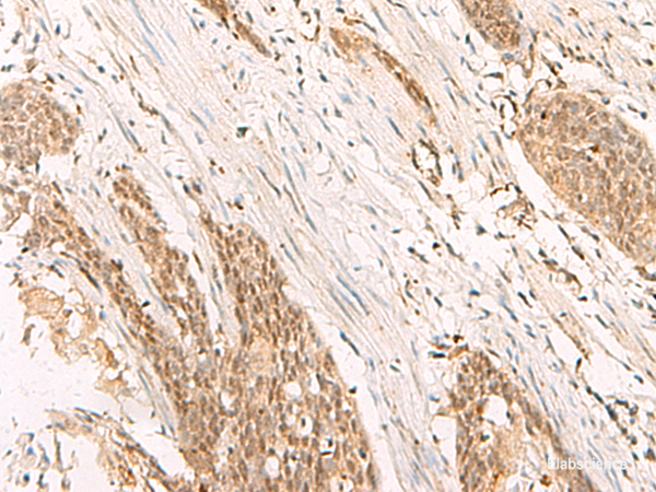 Immunohistochemistry of paraffin-embedded Human esophagus cancer tissue using POP4 Polyclonal Antibody at dilution of 1:65(×200)