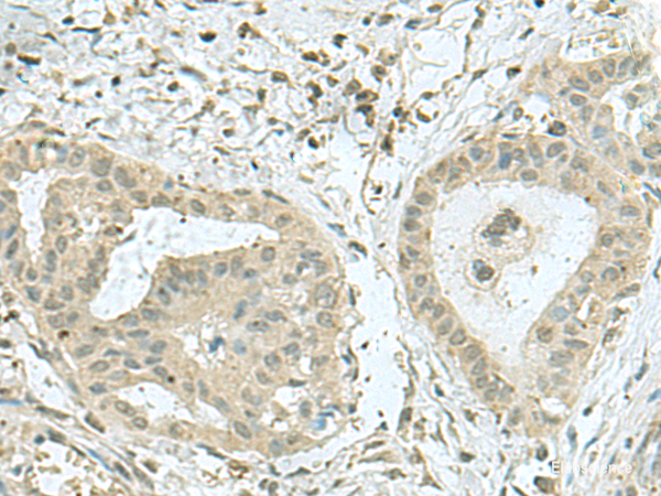 Immunohistochemistry of paraffin-embedded Human thyroid cancer tissue using THTPA Polyclonal Antibody at dilution of 1:70(×200)