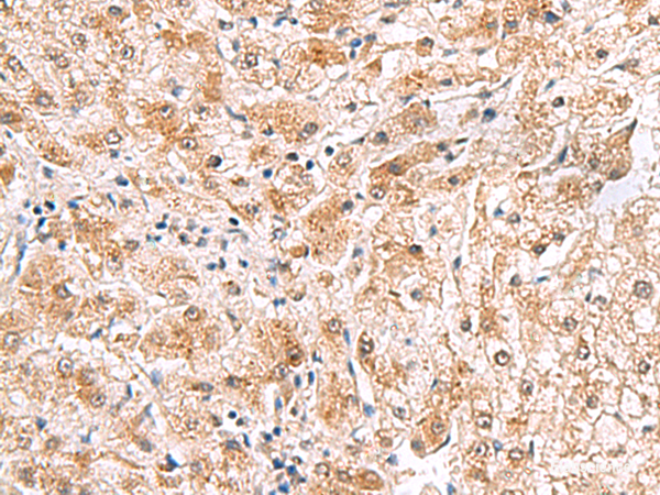 Immunohistochemistry of paraffin-embedded Human liver cancer tissue using PDCL2 Polyclonal Antibody at dilution of 1:65(×200)