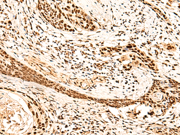 Immunohistochemistry of paraffin-embedded Human esophagus cancer tissue using METTL1 Polyclonal Antibody at dilution of 1:50(×200)