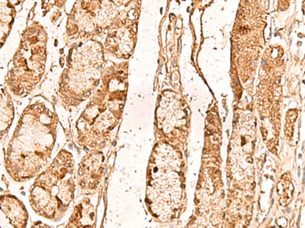 Immunohistochemistry of paraffin-embedded Human liver cancer tissue using WDR33 Polyclonal Antibody at dilution of 1:65(×200)