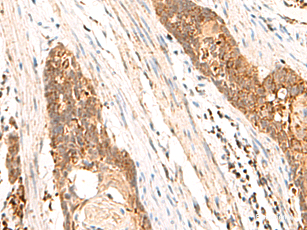 Immunohistochemistry of paraffin-embedded Human esophagus cancer tissue using CYYR1 Polyclonal Antibody at dilution of 1:85(×200)