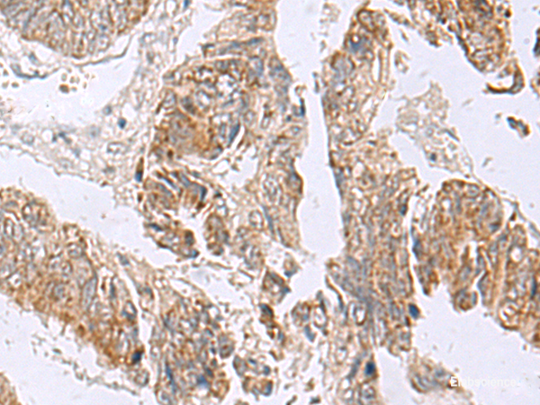 Immunohistochemistry of paraffin-embedded Human colorectal cancer tissue using RTKN2 Polyclonal Antibody at dilution of 1:75(×200)