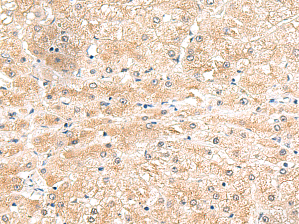 Immunohistochemistry of paraffin-embedded Human liver cancer tissue using LRG1 Polyclonal Antibody at dilution of 1:50(×200)