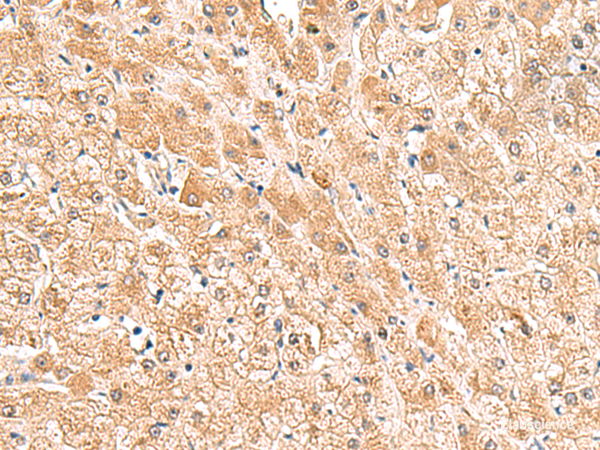Immunohistochemistry of paraffin-embedded Human liver cancer tissue using TRUB1 Polyclonal Antibody at dilution of 1:85(×200)