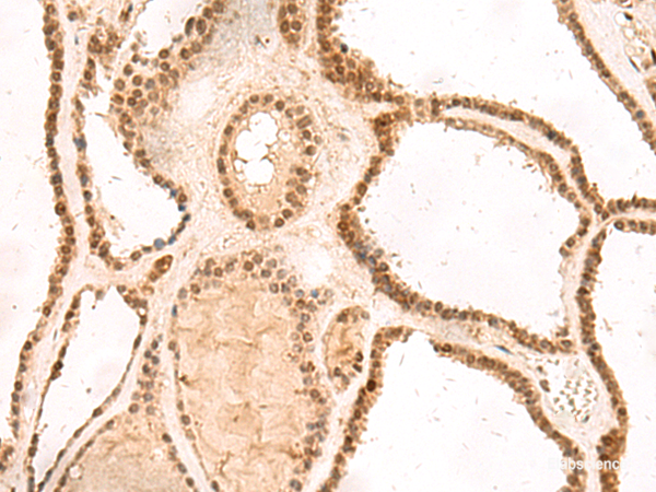 Immunohistochemistry of paraffin-embedded Human thyroid cancer tissue using MKX Polyclonal Antibody at dilution of 1:60(×200)