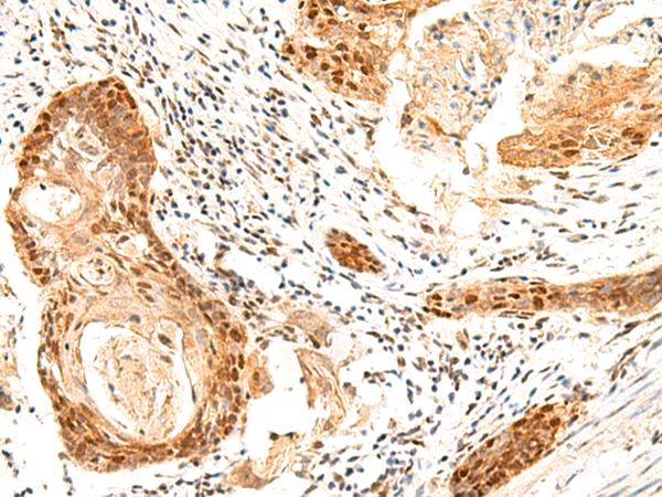 Immunohistochemistry of paraffin-embedded Human esophagus cancer tissue using SETMAR Polyclonal Antibody at dilution of 1:60(×200)