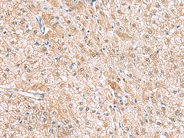 Immunohistochemistry of paraffin-embedded Human liver cancer tissue using HLA-E Polyclonal Antibody at dilution of 1:50(×200)