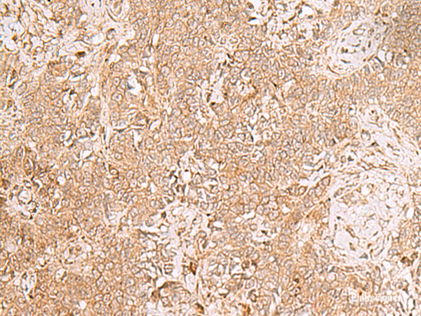 Immunohistochemistry of paraffin-embedded Human ovarian cancer tissue using GMPPB Polyclonal Antibody at dilution of 1:50(×200)