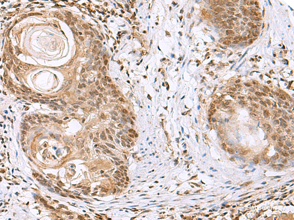 Immunohistochemistry of paraffin-embedded Human esophagus cancer tissue using ELAC1 Polyclonal Antibody at dilution of 1:65(×200)