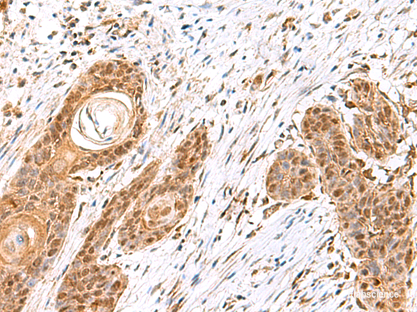 Immunohistochemistry of paraffin-embedded Human esophagus cancer tissue using MECR Polyclonal Antibody at dilution of 1:60(×200)