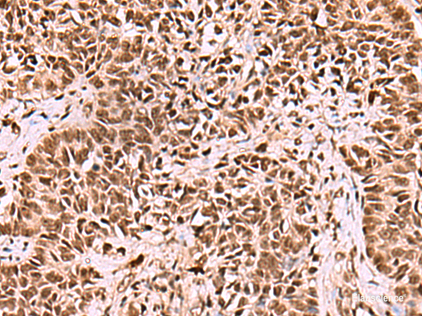 Immunohistochemistry of paraffin-embedded Human ovarian cancer tissue using LDB1 Polyclonal Antibody at dilution of 1:70(×200)
