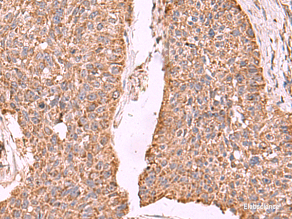Immunohistochemistry of paraffin-embedded Human esophagus cancer tissue using PER3 Polyclonal Antibody at dilution of 1:55(×200)